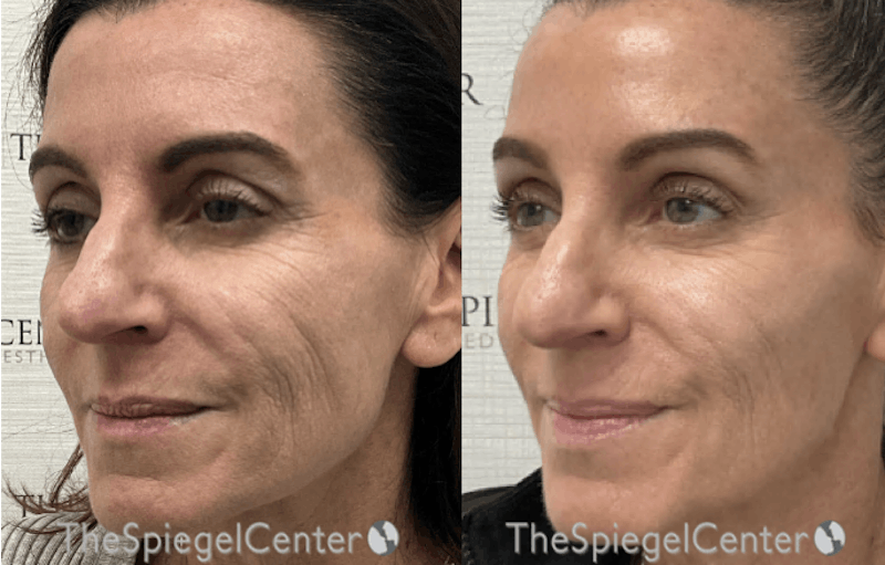 IPL / Intense Pulse Light Before & After Gallery - Patient 362513 - Image 1