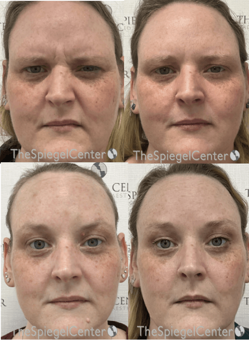 Botox / Dysport / Jeuveau / Xeomin Before & After Gallery - Patient 135076 - Image 1