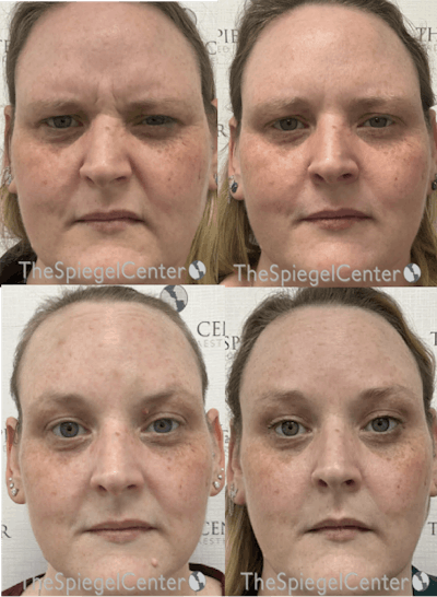 Botox / Dysport / Jeuveau / Xeomin Before & After Gallery - Patient 135076 - Image 1