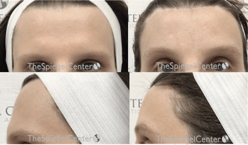 Scalp Advancement Before & After Gallery - Patient 399431 - Image 1
