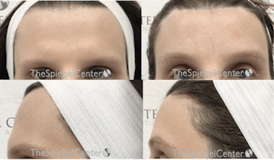 Scalp Advancement Before & After Gallery - Patient 399431 - Image 1