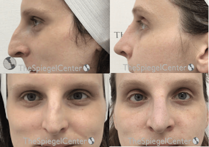 Rhinoplasty Before & After Gallery - Patient 268550 - Image 1