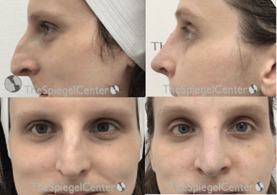 Rhinoplasty Before & After Gallery - Patient 268550 - Image 1
