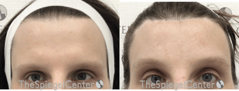 Browlift / Fox Eye Lift Before & After Gallery - Patient 157527 - Image 1