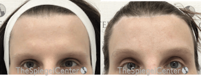 Browlift / Fox Eye Lift Before & After Gallery - Patient 157527 - Image 1