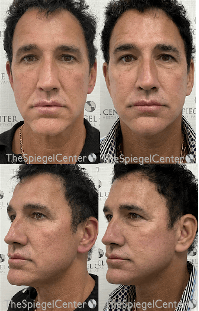 Facelift Before & After Gallery - Patient 252859 - Image 1