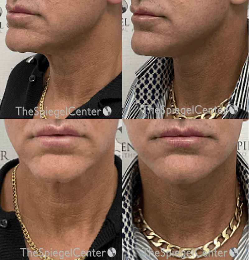Neck Lift Before & After Gallery - Patient 815252 - Image 1