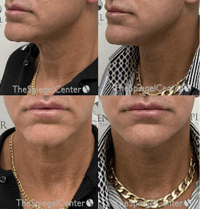 Neck Lift Before & After Gallery - Patient 815252 - Image 1