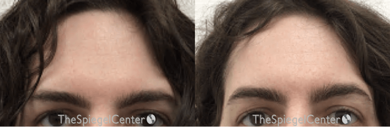 Browlift / Fox Eye Lift Before & After Gallery - Patient 324394 - Image 1