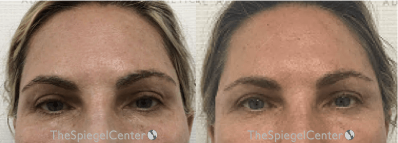 Temple Filler Before & After Gallery - Patient 286967 - Image 1