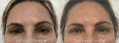 Temple Filler Before & After Gallery - Patient 286967 - Image 1