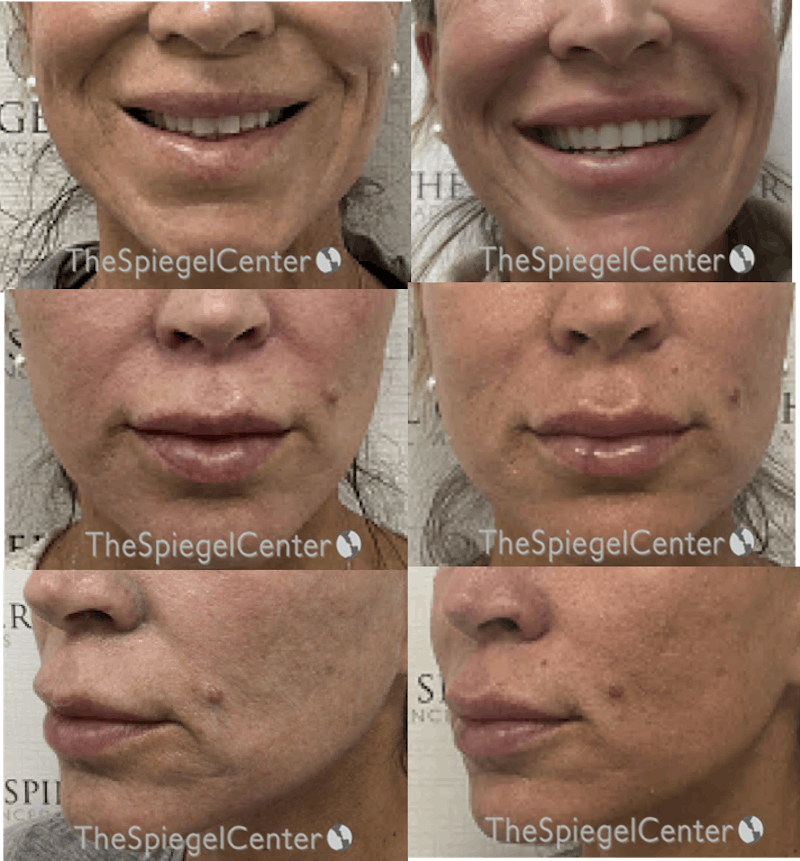 Lip Filler Before & After Gallery - Patient 199325 - Image 1
