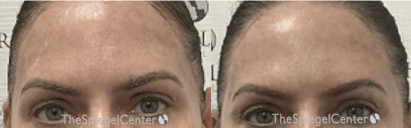 Temple Filler Before & After Gallery - Patient 868292 - Image 1