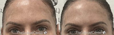 Temple Filler Before & After Gallery - Patient 868292 - Image 1