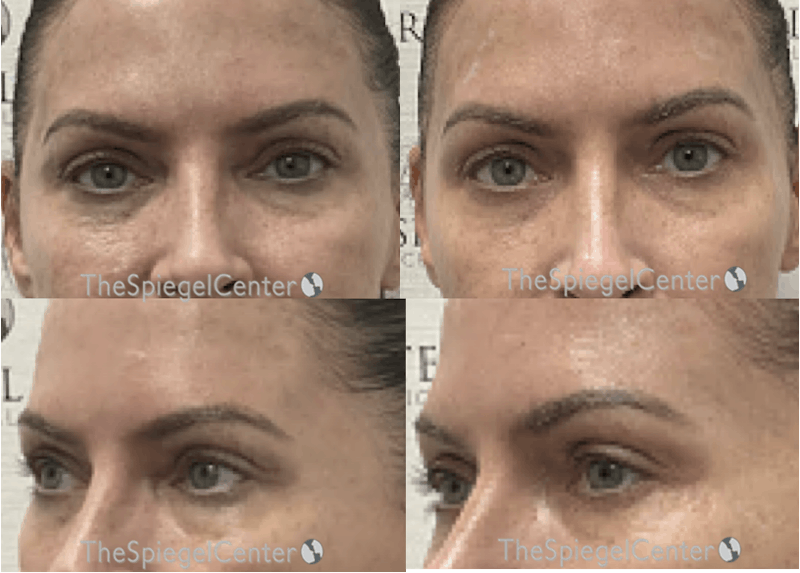 Upper Eyelid Filler Before & After Gallery - Patient 359748 - Image 1