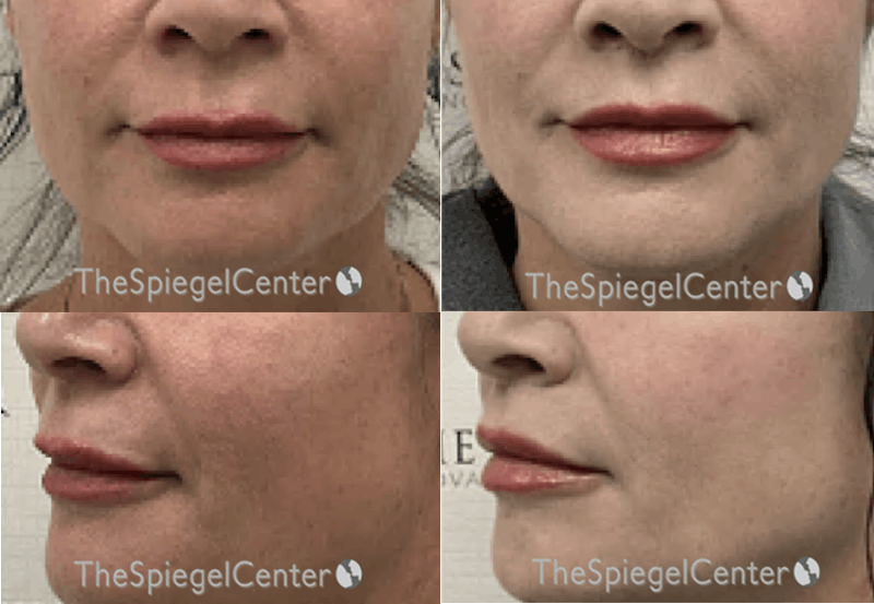 Lip Lift Before & After Gallery - Patient 477825 - Image 1