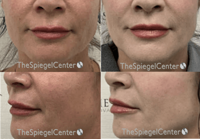 Lip Lift Before & After Gallery - Patient 477825 - Image 1