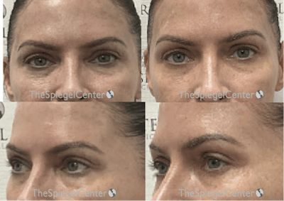 Tear Trough / Under Eye Fillers Before & After Gallery - Patient 197562 - Image 1