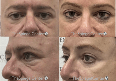Blepharoplasty Before & After Gallery - Patient 175717 - Image 1