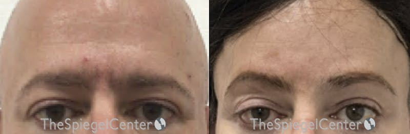 Browlift / Fox Eye Lift Before & After Gallery - Patient 416172 - Image 1