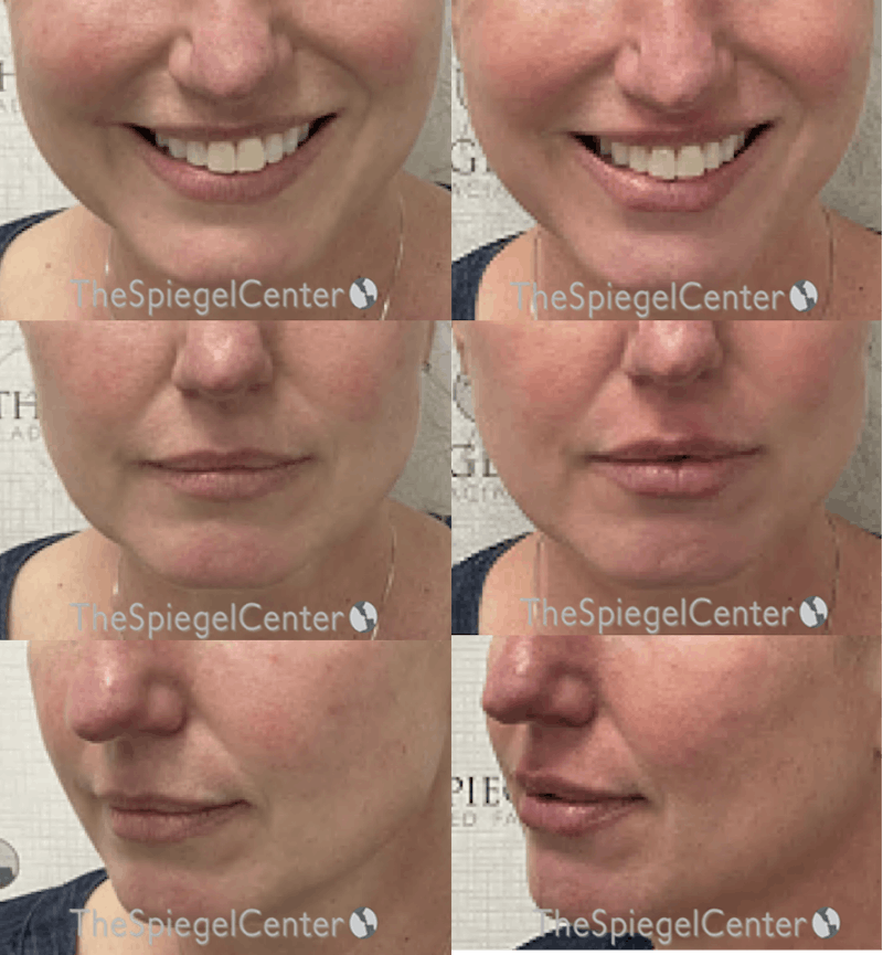 Lip Filler Before & After Gallery - Patient 279793 - Image 1
