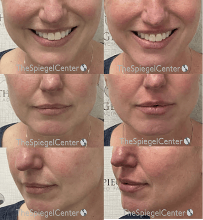 Lip Filler Before & After Gallery - Patient 279793 - Image 1