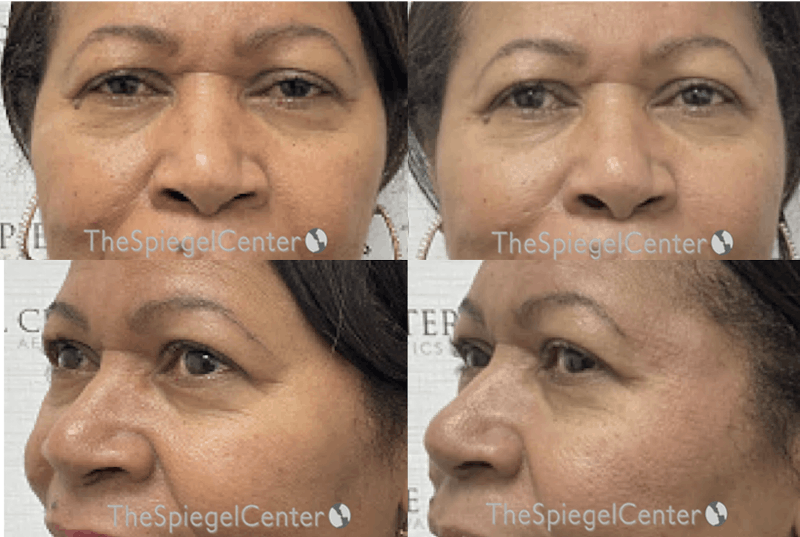 Non-Surgical Rhinoplasty / Nose Filler Before & After Gallery - Patient 256757 - Image 1