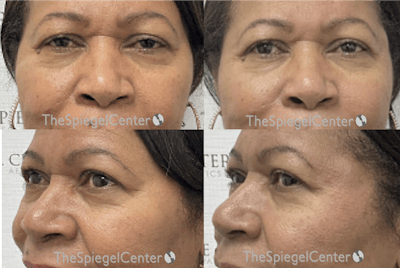 Non-Surgical Rhinoplasty / Nose Filler Before & After Gallery - Patient 256757 - Image 1