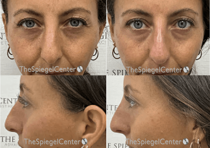 Non-Surgical Rhinoplasty / Nose Filler Before & After Gallery - Patient 256148 - Image 1