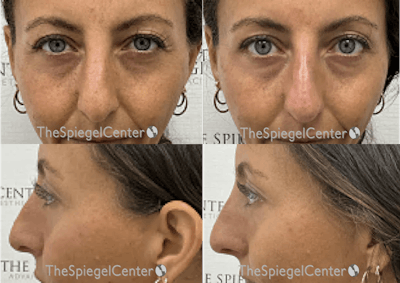 Non-Surgical Rhinoplasty / Nose Filler Before & After Gallery - Patient 256148 - Image 1