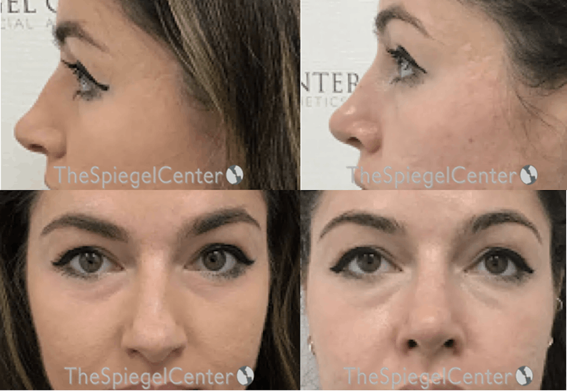 Rhinoplasty Before & After Gallery - Patient 496366 - Image 1