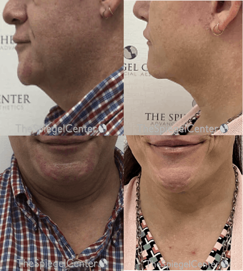 Neck Lipo Before & After Gallery - Patient 420220 - Image 1