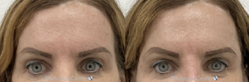 Temple Filler Before & After Gallery - Patient 189983 - Image 1