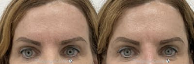 Temple Filler Before & After Gallery - Patient 189983 - Image 1