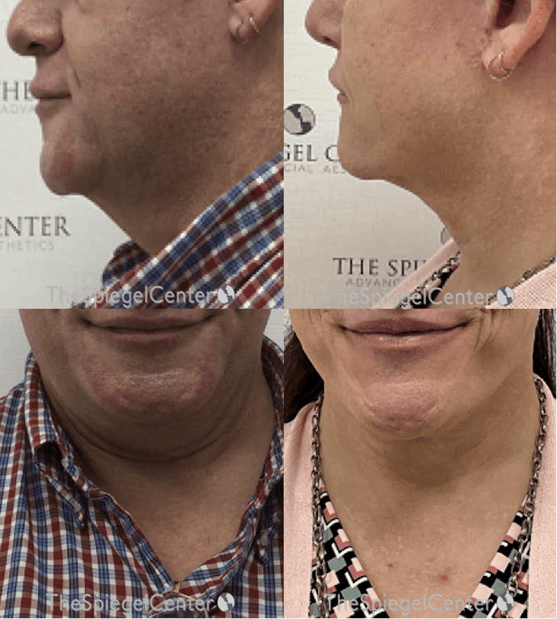 Neck Lift Before & After Gallery - Patient 424569 - Image 1