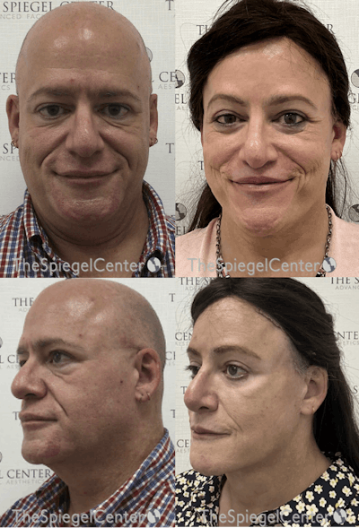 FFS Before & After Gallery - Patient 278806 - Image 1