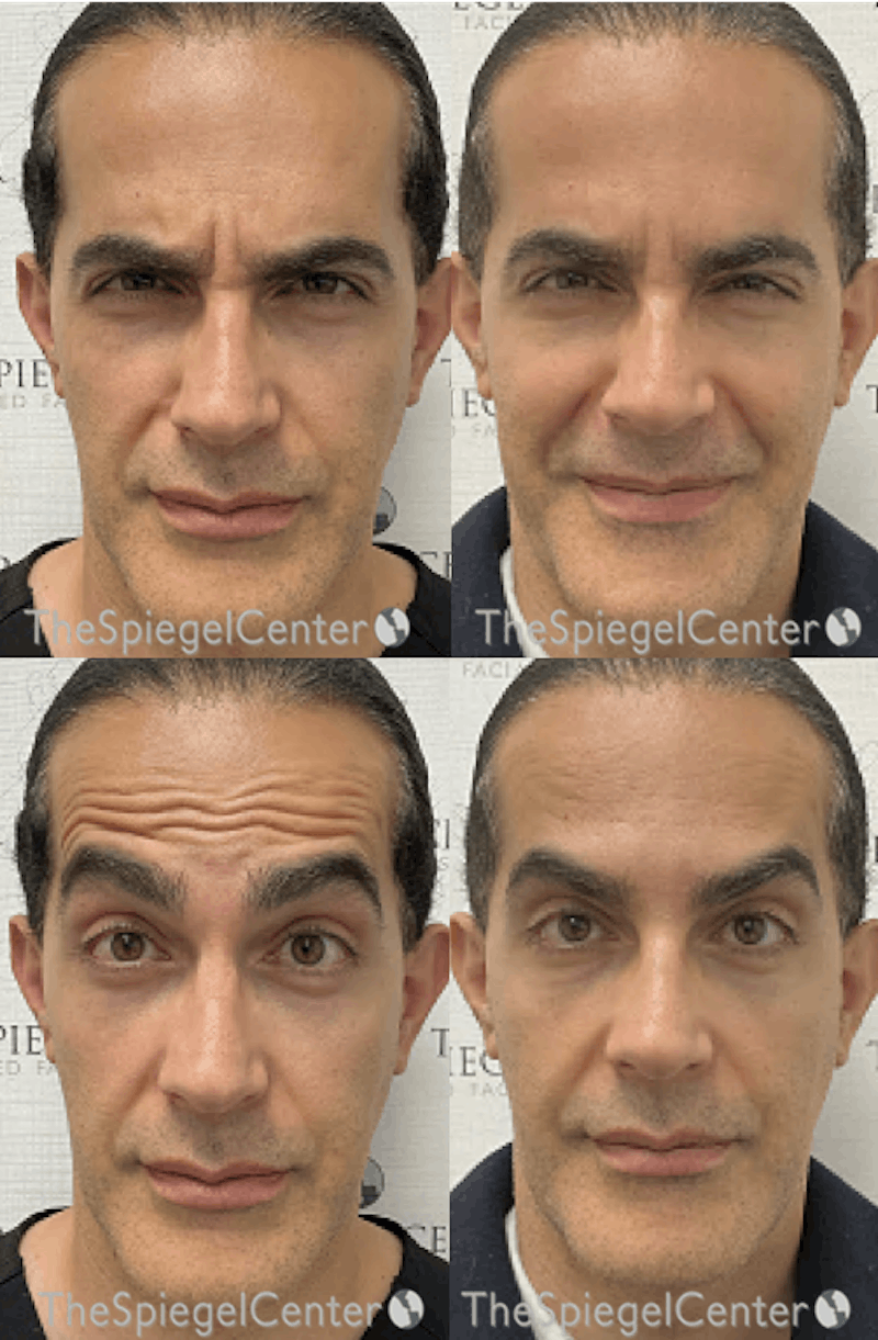 Botox / Dysport / Jeuveau / Xeomin Before & After Gallery - Patient 344148 - Image 1