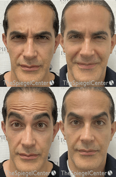 Botox / Dysport / Jeuveau / Xeomin Before & After Gallery - Patient 344148 - Image 1