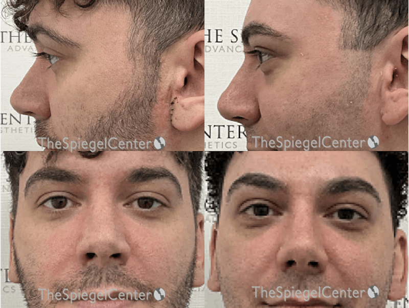 Rhinoplasty Before & After Gallery - Patient 157140022 - Image 1