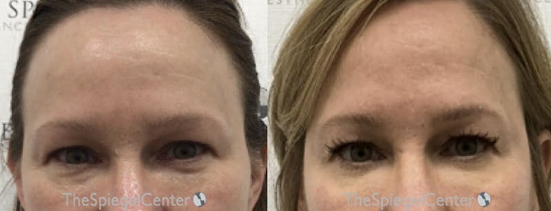 Temple Filler Before & After Gallery - Patient 412820 - Image 1
