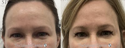 Temple Filler Before & After Gallery - Patient 412820 - Image 1