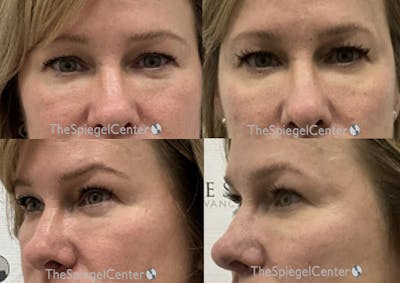 Tear Trough / Under Eye Fillers Before & After Gallery - Patient 125307 - Image 1