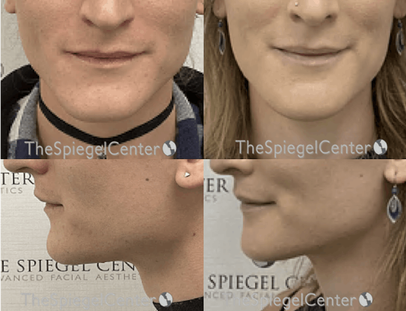 Mandible Contouring Before & After Gallery - Patient 324418 - Image 1