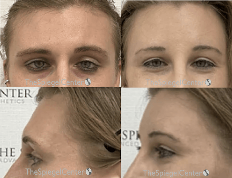 Forehead Contouring Before & After Gallery - Patient 874063 - Image 1