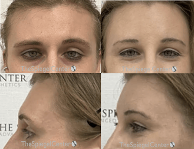 Forehead Contouring Before & After Gallery - Patient 874063 - Image 1