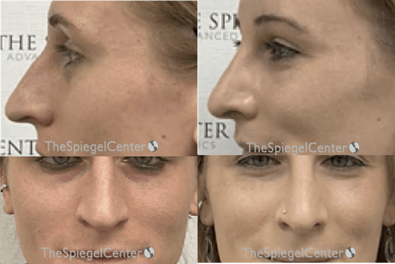 Cheek Implants Before & After Gallery - Patient 315112 - Image 1