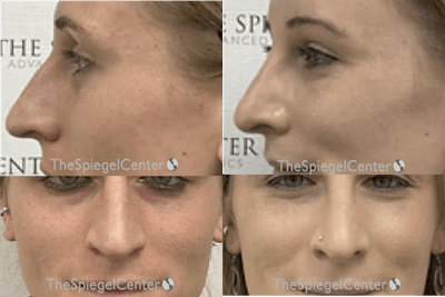 Cheek Implants Before & After Gallery - Patient 315112 - Image 1