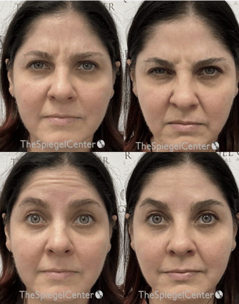 Botox / Dysport / Jeuveau / Xeomin Before & After Gallery - Patient 175208 - Image 1