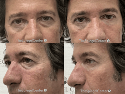 Tear Trough / Under Eye Fillers Before & After Gallery - Patient 304234 - Image 1