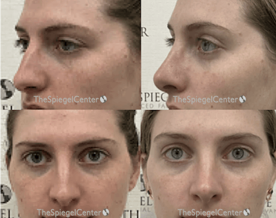 Rhinoplasty Before & After Gallery - Patient 133563 - Image 1